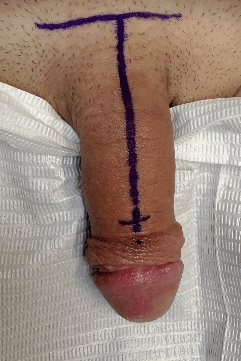 Penile Enlargement Before & After Gallery - Patient 255846 - Image 1