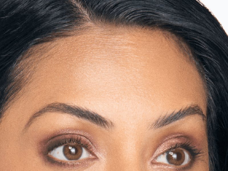 Xeomin Before & After Gallery - Patient 558456 - Image 2