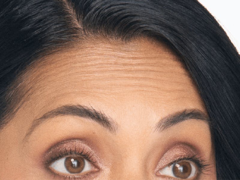 Xeomin Before & After Gallery - Patient 558456 - Image 1