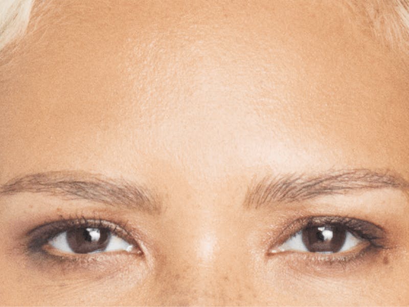 Xeomin Before & After Gallery - Patient 439943 - Image 1
