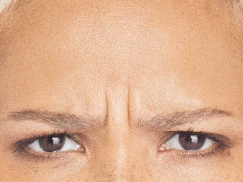 Xeomin Before & After Gallery - Patient 439943 - Image 2