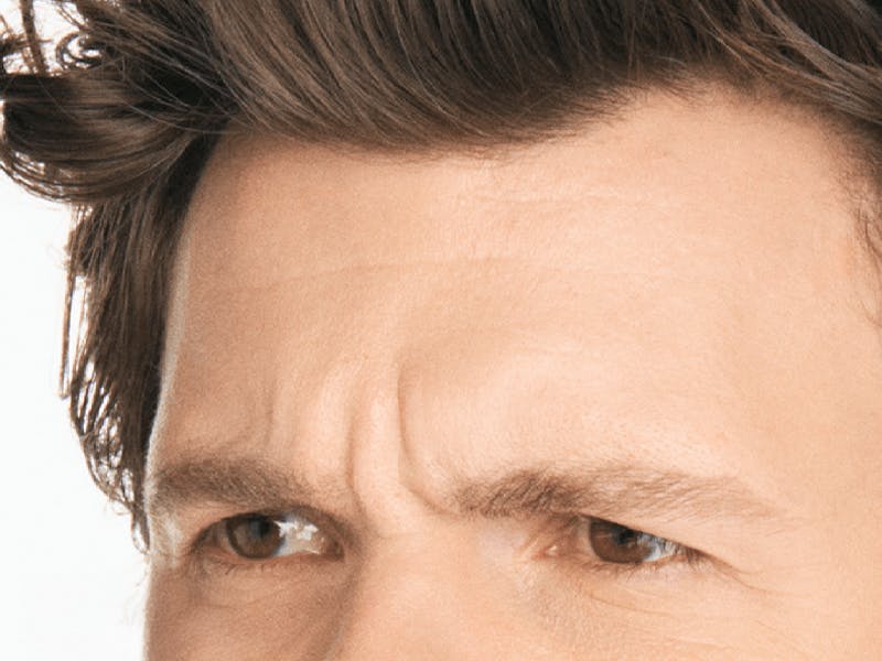 Xeomin Before & After Gallery - Patient 363860 - Image 1