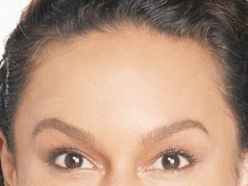 Xeomin Before & After Gallery - Patient 166339 - Image 2