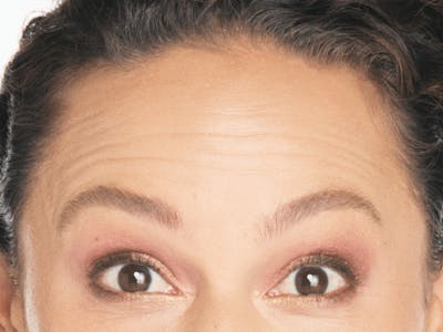 Xeomin Before & After Gallery - Patient 166339 - Image 1