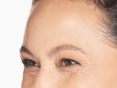 Xeomin Before & After Gallery - Patient 974829 - Image 2