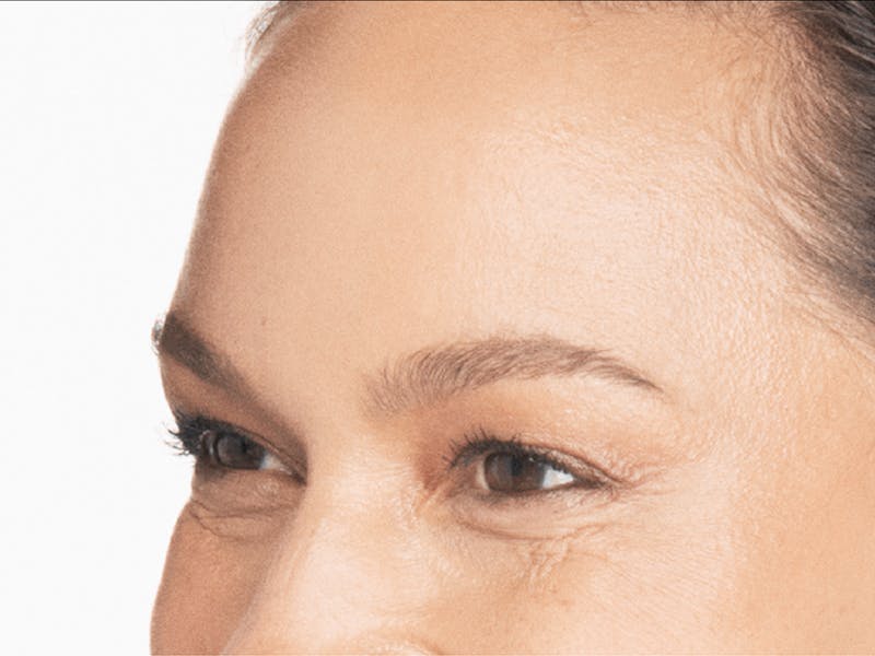 Xeomin Before & After Gallery - Patient 974829 - Image 1