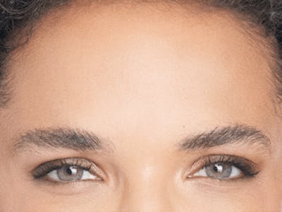 Xeomin Before & After Gallery - Patient 296972 - Image 2