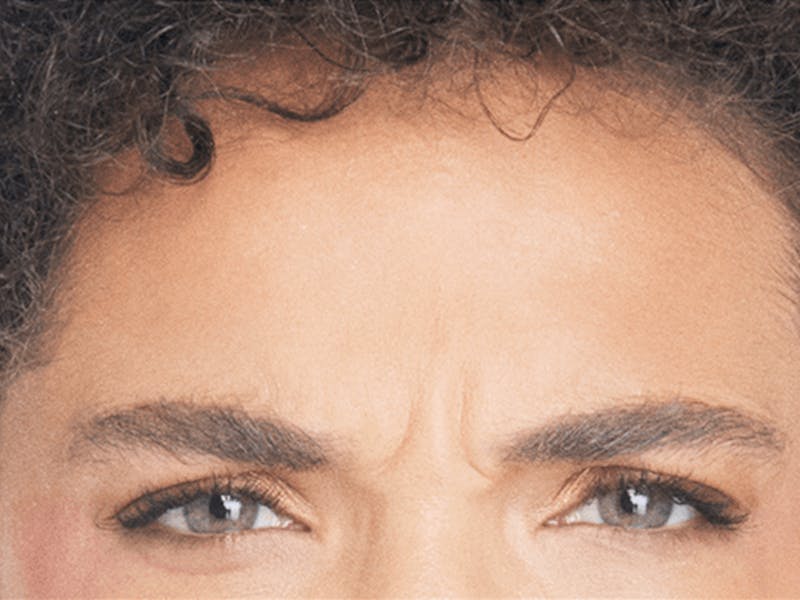 Xeomin Before & After Gallery - Patient 296972 - Image 1