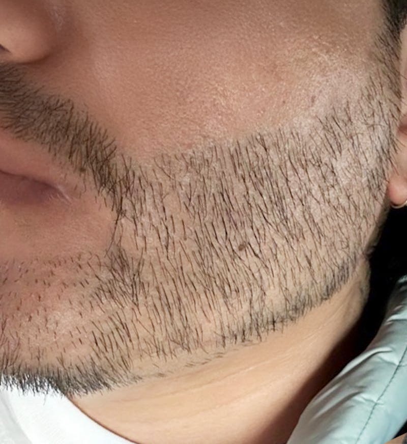 Beard Transplant Before & After Gallery - Patient 277018 - Image 2