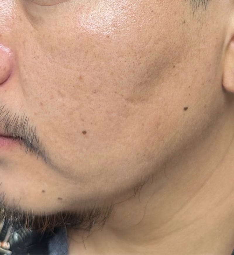 Beard Transplant Before & After Gallery - Patient 277018 - Image 1