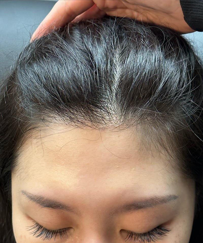 Womens Female Hair Transplant Before & After Gallery - Patient 565590 - Image 2