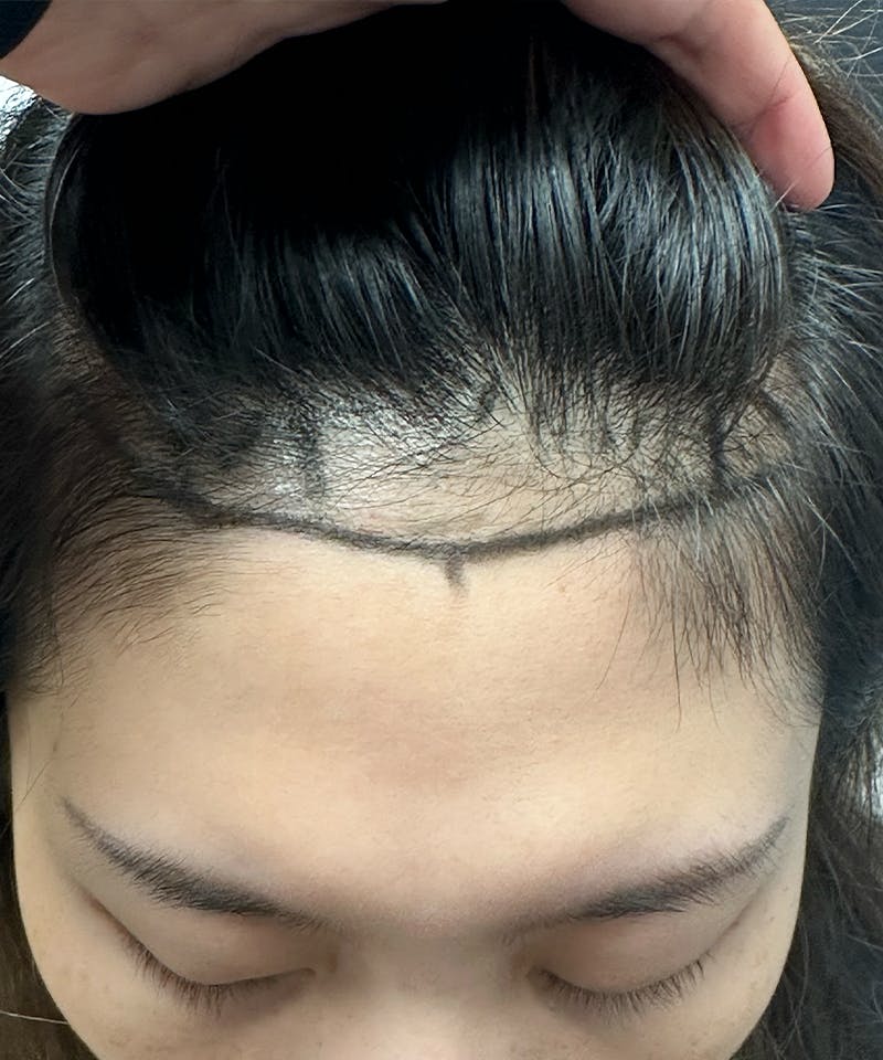 Womens Female Hair Transplant Before & After Gallery - Patient 565590 - Image 1