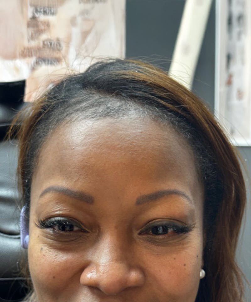 Womens Female Hair Transplant Before & After Gallery - Patient 164010 - Image 2