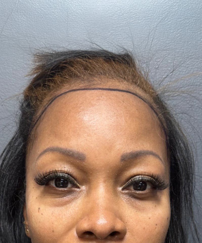 Womens Female Hair Transplant Before & After Gallery - Patient 164010 - Image 1