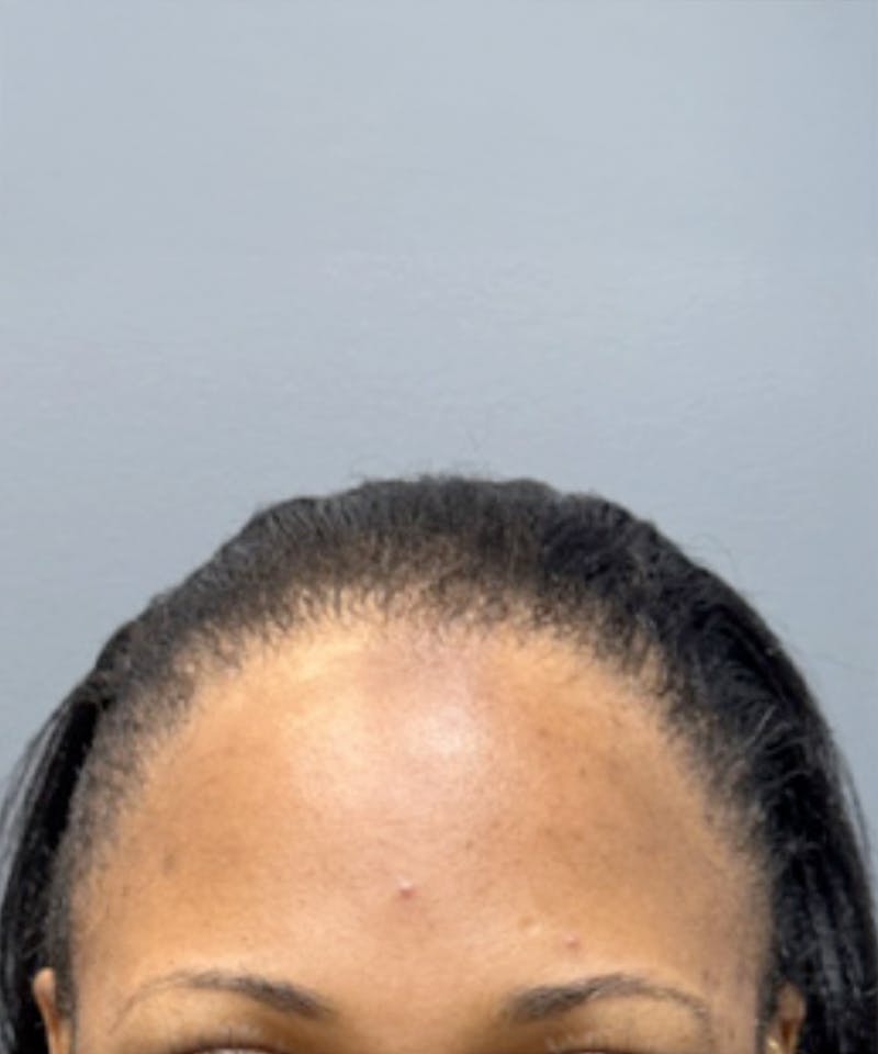Womens Female Hair Transplant Before & After Gallery - Patient 362562 - Image 2