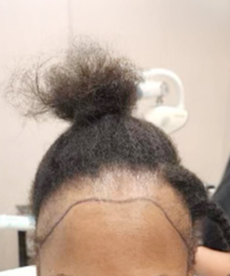 Womens Female Hair Transplant Before & After Gallery - Patient 362562 - Image 1