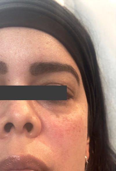 Cheek Fillers Before & After Gallery - Patient 414947 - Image 2