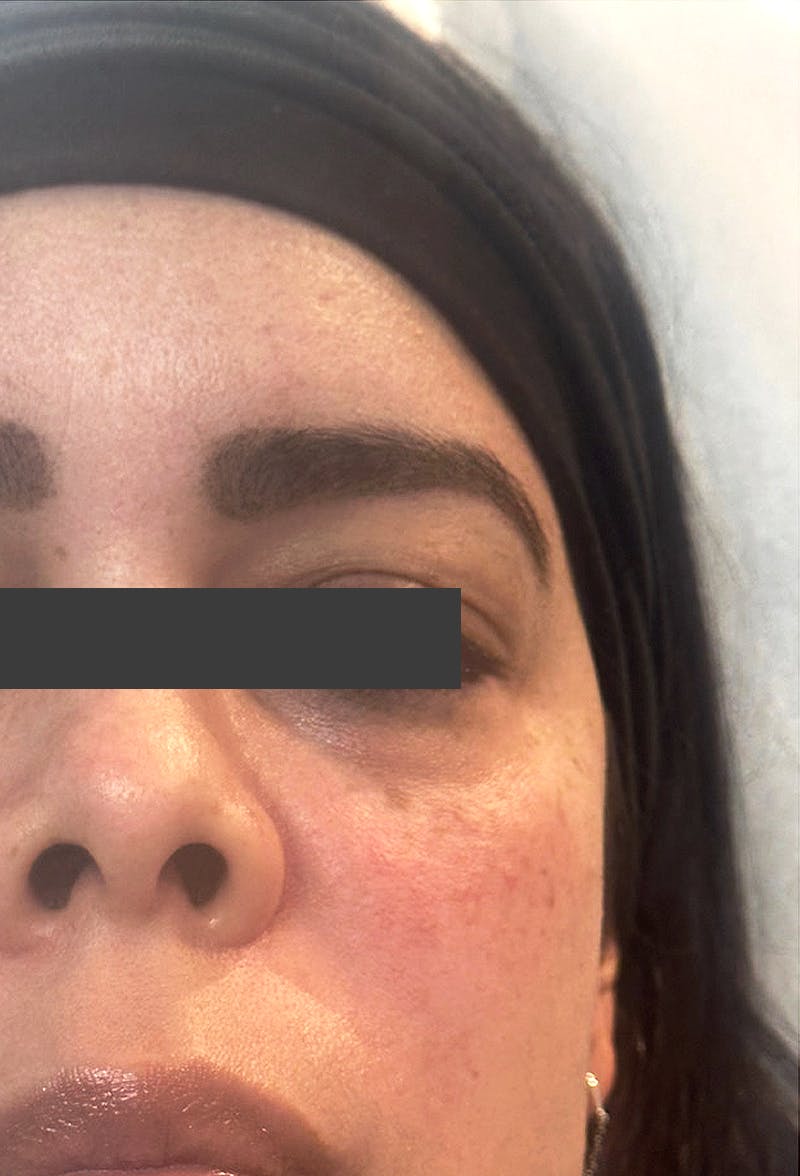 Cheek Fillers Before & After Gallery - Patient 414947 - Image 2