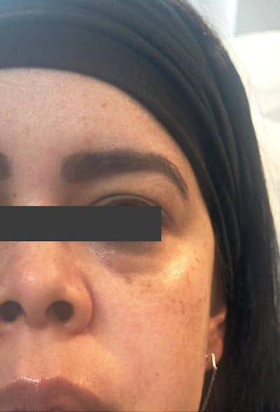 Cheek Fillers Before & After Gallery - Patient 414947 - Image 1
