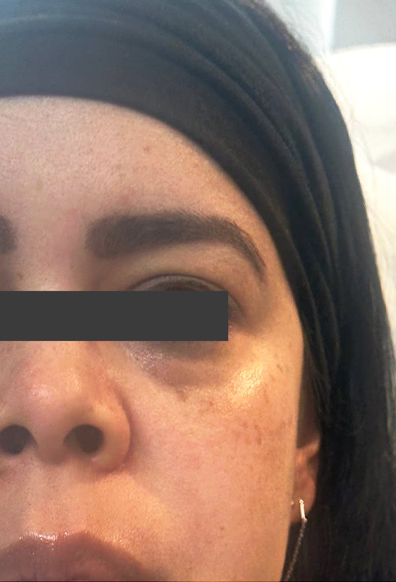 Cheek Fillers Before & After Gallery - Patient 414947 - Image 1
