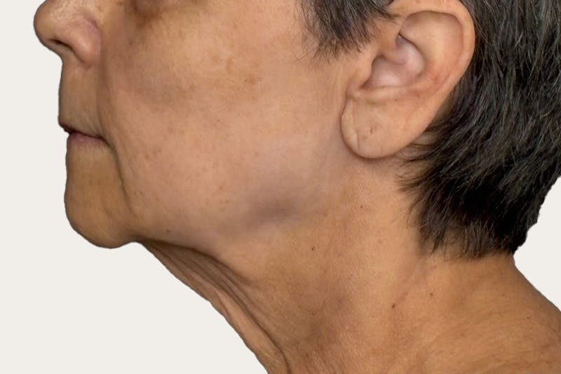 Neck Lift Surgery Before & After Gallery - Patient 265286 - Image 1