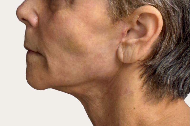 Neck Lift Surgery Before & After Gallery - Patient 265286 - Image 2