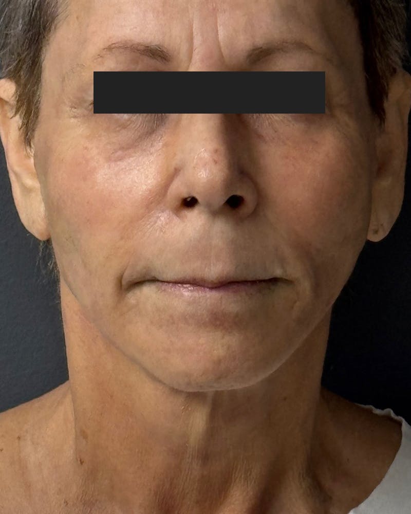 Face Lift Before & After Gallery - Patient 105491 - Image 2