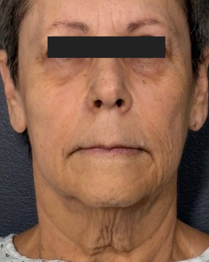 Face Lift Before & After Gallery - Patient 105491 - Image 1