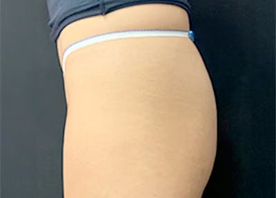Emsculpt Before & After Gallery - Patient 174335 - Image 1