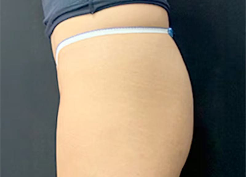 Emsculpt Before & After Gallery - Patient 174335 - Image 1