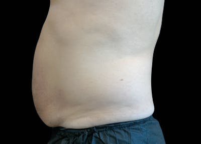 Emsculpt Before & After Gallery - Patient 221519 - Image 1