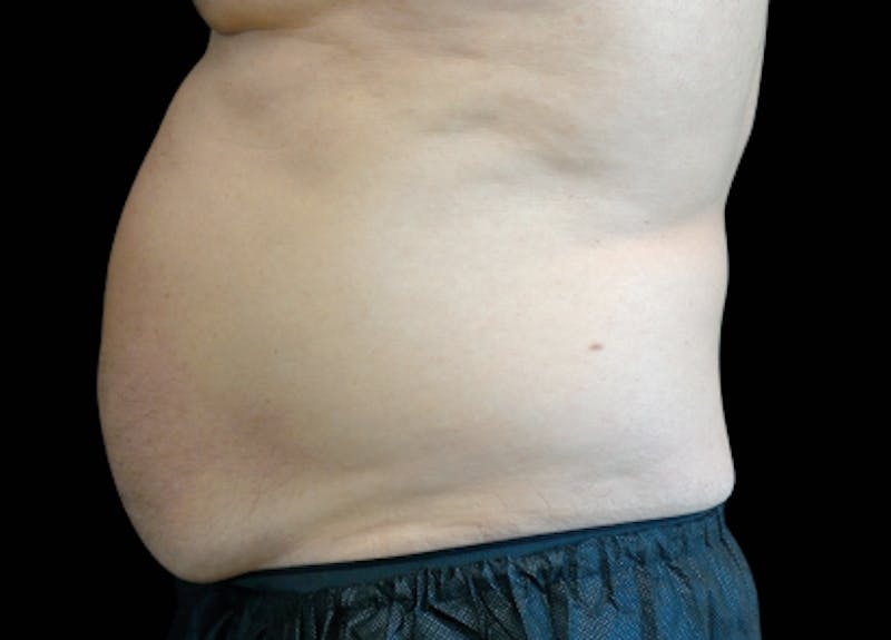Emsculpt Before & After Gallery - Patient 221519 - Image 2