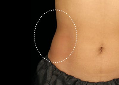 Emsculpt Before & After Gallery - Patient 588854 - Image 2