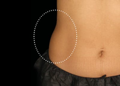 Emsculpt Before & After Gallery - Patient 588854 - Image 1