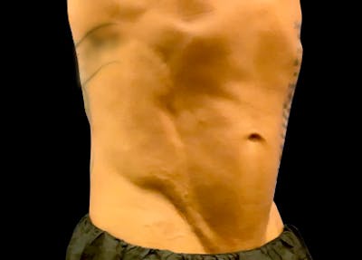 Emsculpt Before & After Gallery - Patient 272548 - Image 2