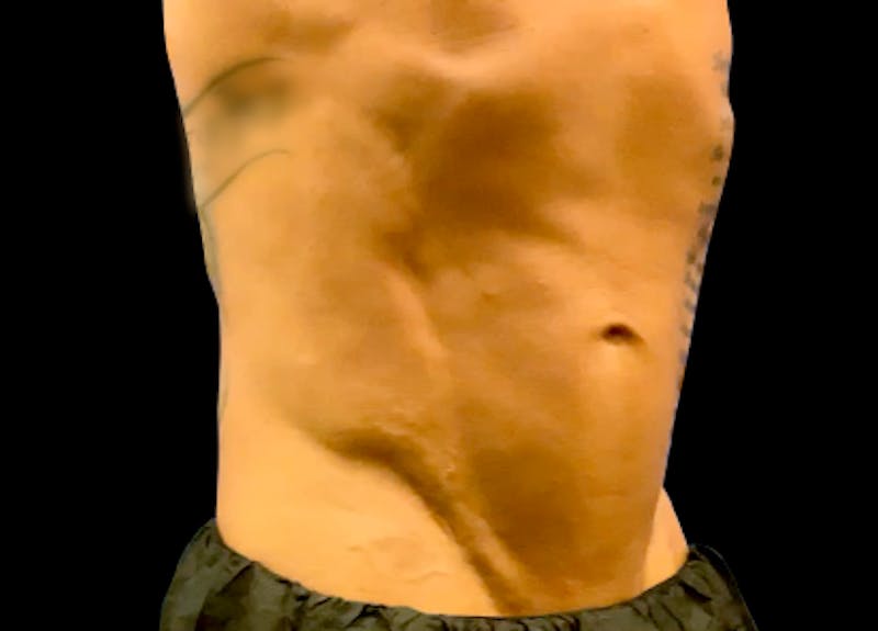 Emsculpt Before & After Gallery - Patient 272548 - Image 2