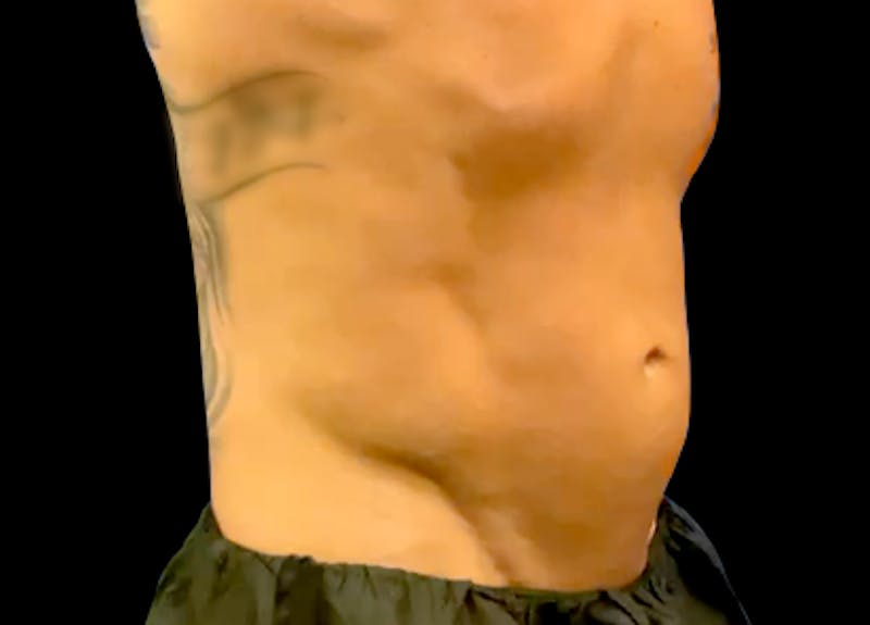 Emsculpt Before & After Gallery - Patient 272548 - Image 1