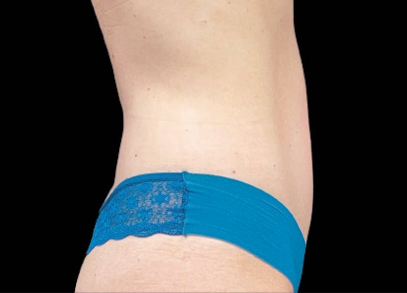 Emsculpt Before & After Gallery - Patient 198706 - Image 2