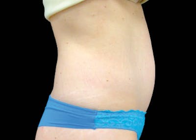 Emsculpt Before & After Gallery - Patient 198706 - Image 1