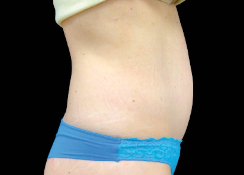 Emsculpt Before & After Gallery - Patient 198706 - Image 1