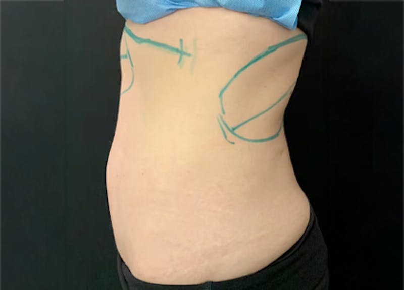 Emsculpt Before & After Gallery - Patient 237904 - Image 1