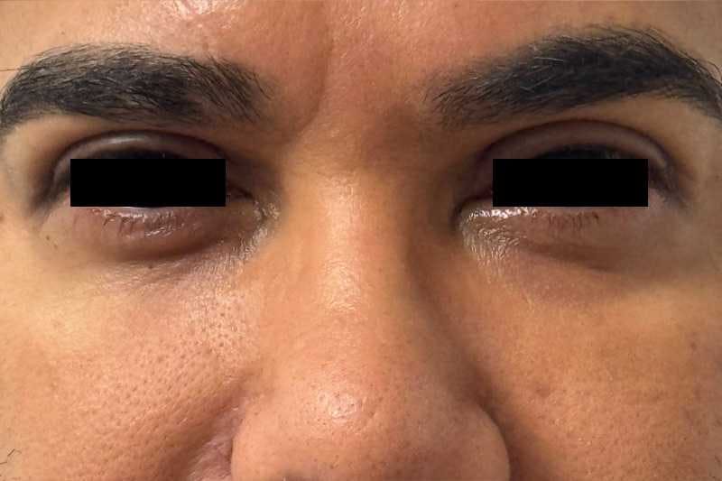 Eye Lift Before & After Gallery - Patient 413544 - Image 1