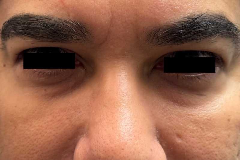 Eye Lift Before & After Gallery - Patient 413544 - Image 2