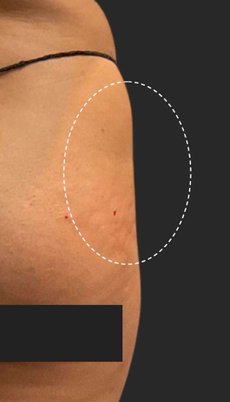 Buttlift & Hip Dips Before & After Gallery - Patient 186857 - Image 2