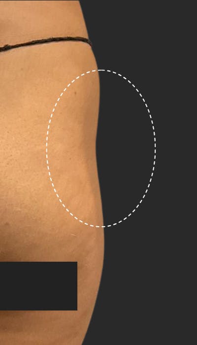 Buttlift & Hip Dips Before & After Gallery - Patient 186857 - Image 1