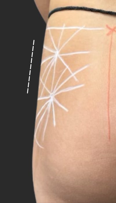 Buttlift & Hip Dips Before & After Gallery - Patient 149311 - Image 1