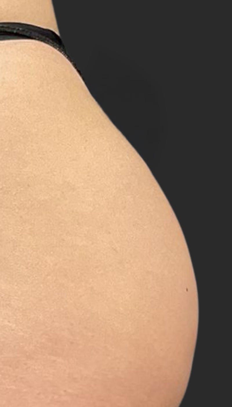 Buttlift & Hip Dips Before & After Gallery - Patient 517263 - Image 1