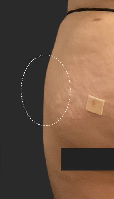 Buttlift & Hip Dips Before & After Gallery - Patient 164412 - Image 2