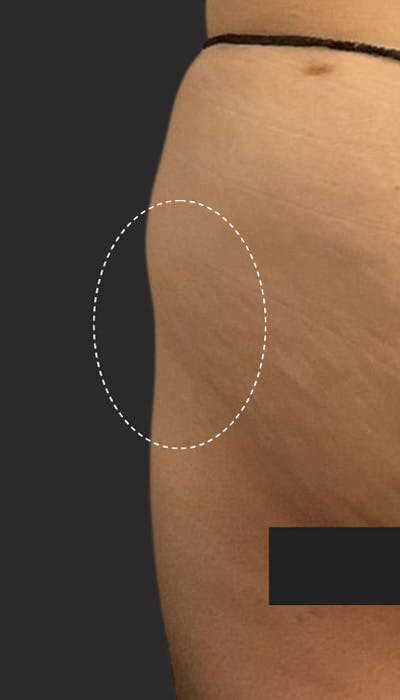 Buttlift & Hip Dips Before & After Gallery - Patient 164412 - Image 1