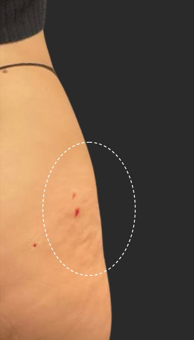 Buttlift & Hip Dips Before & After Gallery - Patient 328805 - Image 2
